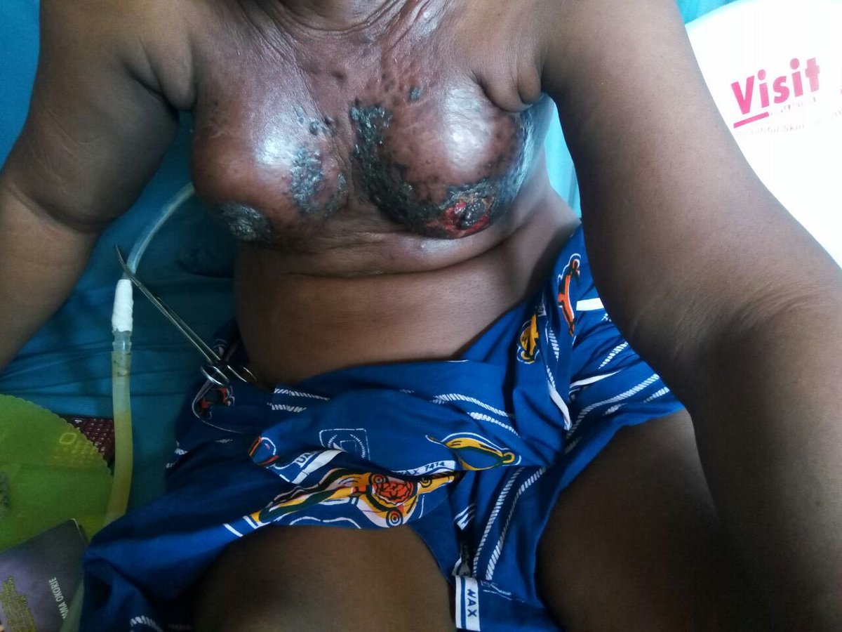 amanshailli's tweet photo. The image shows a person with significant chest wounds and a medical drain in place, likely due to a severe infection or other serious condition. Immediate medical attention is recommended. https://t.co/tbUsSkVyGH