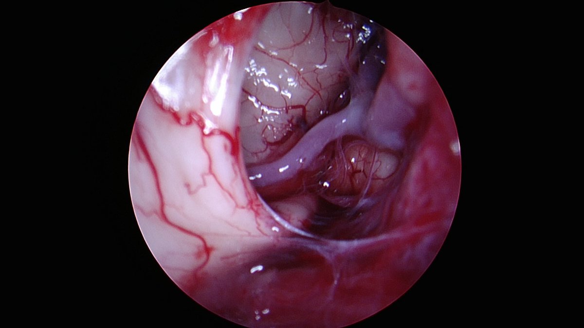Dr Amir R. Dehdashti (@amirdehdashti) on Twitter photo Endoscopic endonasal extraarachnoid microdissection via MOCR using angled scopes allows complete resection of eccentric macroadenomas lateral to carotid. Look at the beautiful view of ICA bifurcation, proximal sylvian fissure and lenticulostriates after final resection <a href="/NASBSorg/">NASBS</a> Endoscopic endonasal extraarachnoid microdissection via MOCR using angled scopes allows complete resection of eccentric macroadenomas lateral to carotid. Look at the beautiful view of ICA bifurcation, proximal sylvian fissure and lenticulostriates after final resection <a href="/NASBSorg/">NASBS</a>