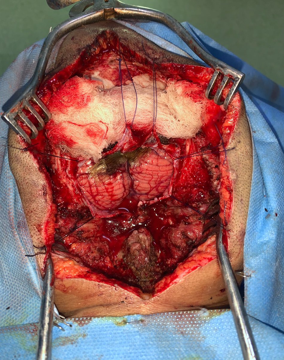 amanshailli's tweet photo. The image depicts a neurosurgical procedure involving the placement of a dural substitute or graft. This is likely being used to repair or reinforce the dura mater, the outermost membrane covering the brain and spinal cord, after a craniotomy or other brain surgery. https://t.co/dV9kSEUZi9