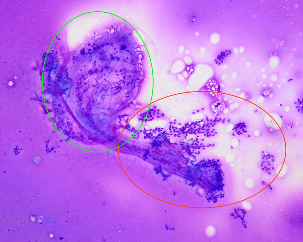 pepeheffernan's tweet photo. CC335. Jorge has been a great student and his final thesis on false negative FNAB diagnoses of thyroid papillary carcinoma scored 10/10. Cyto has to be in medical schools. This was diagnosed (by me) as B2. What other tissue (green) seems to accompany the epithelium (red)? more⬇️ https://t.co/7PwfMOP7ZF