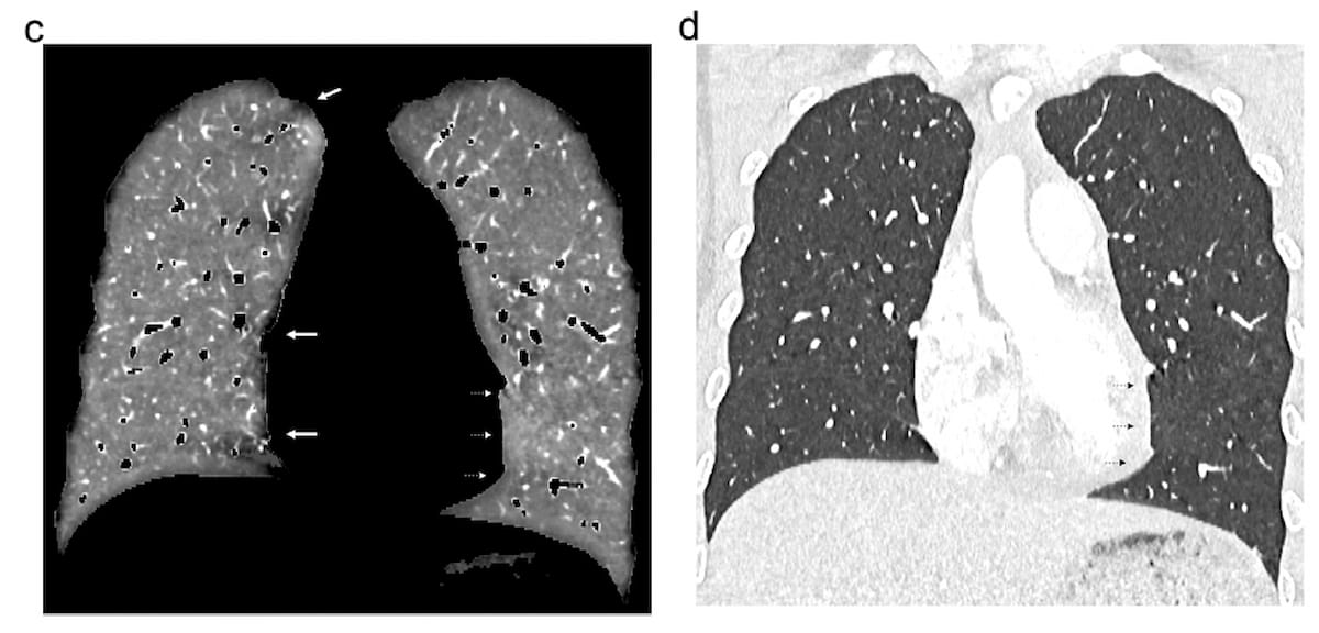 Can Photon-Counting CT Provide Superior Lung Perfusion Imaging Over Dual-Energy CT?
diagnosticimaging.com/view/photon-co…
<a href="/ACRRFS/">ACR RFS - We've Moved! Follow <a href="/RadiologyACR/">American College of Radiology</a>.</a> <a href="/ACRYPS/">ACR YPS- We've Moved! Follow @RadiologyACR.</a> @RadiologyACR <a href="/ARRS_Radiology/">ARRS</a> <a href="/thoracicrad/">Society of Thoracic Radiology</a> <a href="/DukeRadiology/">Duke Radiology</a> @EmoryRadiology <a href="/YaleRadiology/">Yale Department of Radiology & Biomedical Imaging</a> <a href="/PennRadiology/">Penn Radiology</a> <a href="/NYUImaging/">NYU Langone Health Department of Radiology</a> <a href="/UABRadiology/">UAB Radiology</a> 
#radiology #RadRes #CTRad