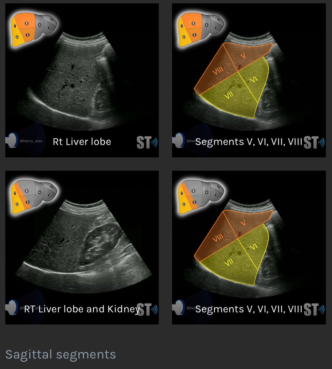 Shaman___S's tweet photo. Liver Segments 
مهم تعرفها وتعرف تقسيمتها بس لاتتعب نفسك في حفظها اذا انت في بداياتك https://t.co/d8GWWnMLJt