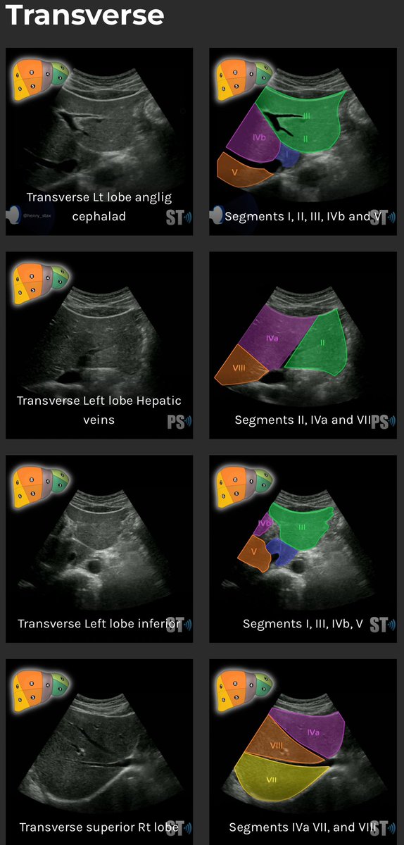 Shaman___S's tweet photo. Liver Segments 
مهم تعرفها وتعرف تقسيمتها بس لاتتعب نفسك في حفظها اذا انت في بداياتك https://t.co/d8GWWnMLJt