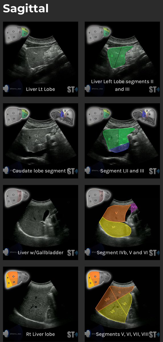 Shaman___S's tweet photo. Liver Segments 
مهم تعرفها وتعرف تقسيمتها بس لاتتعب نفسك في حفظها اذا انت في بداياتك https://t.co/d8GWWnMLJt