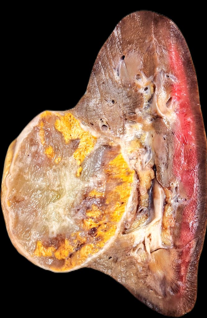 mdleandroo's tweet image. F, 40y, kidney tumor: clear cell renal carcinoma with myxoid degeneration!
#pathtwitter #grosspath