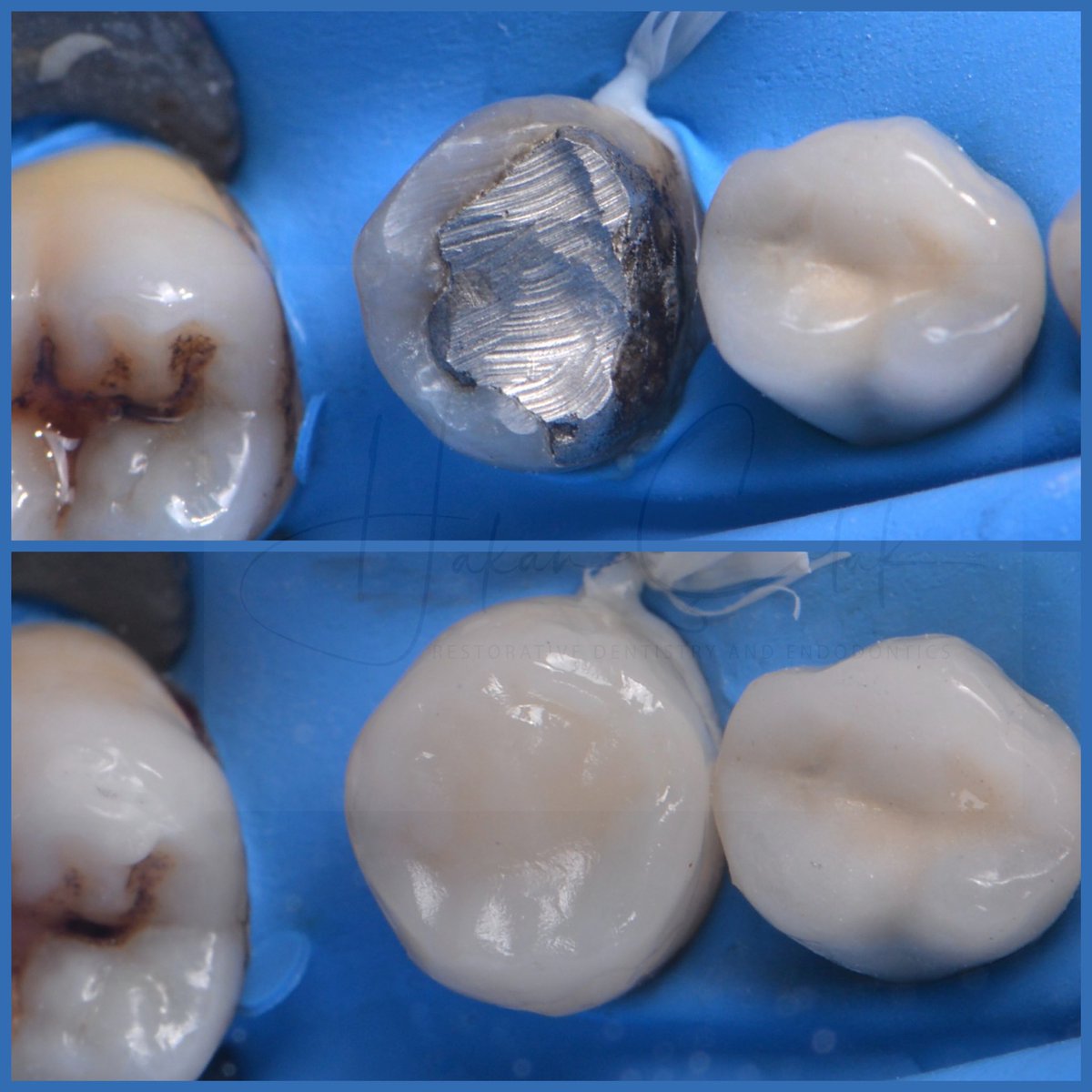 Direkt kompozit overlay