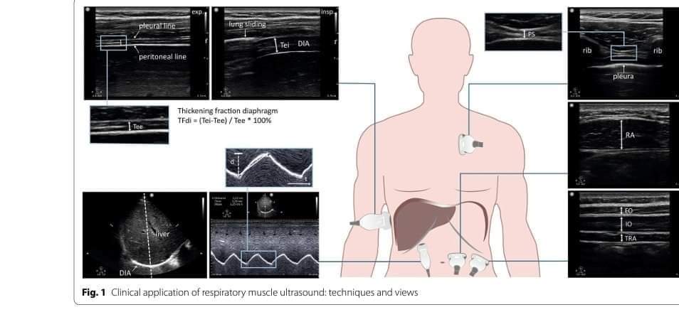 LeslieMegom's tweet photo. 🔎POCUS en pacientes con fracaso⬇️ del Weaning: Abordaje ABCDE.🧑‍⚕️👩🏽‍⚕️
👇👇👇👇👇
https://t.co/VBSjshqKka
🗝🔒https://t.co/cpZ0nI6ePh https://t.co/AjvUxYU1U4
