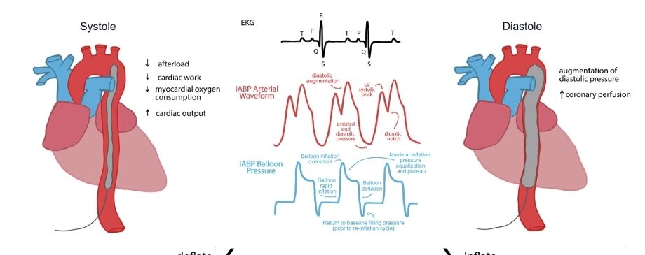 LeslieMegom's tweet photo. 💥🫀El balón intraaórtico de contrapulsación (BIACP) .Revisión enfocada de la fisiología, función,  repercusión y complicaciones.
◾️ El BIACP afecta el GC y la perfusión coronaria.  Inmediatamente antes de la sístole (intervalo QRS-T), el balón se desinfla rápidamente. 👇🏽hilo https://t.co/S5gLZ5nO0M