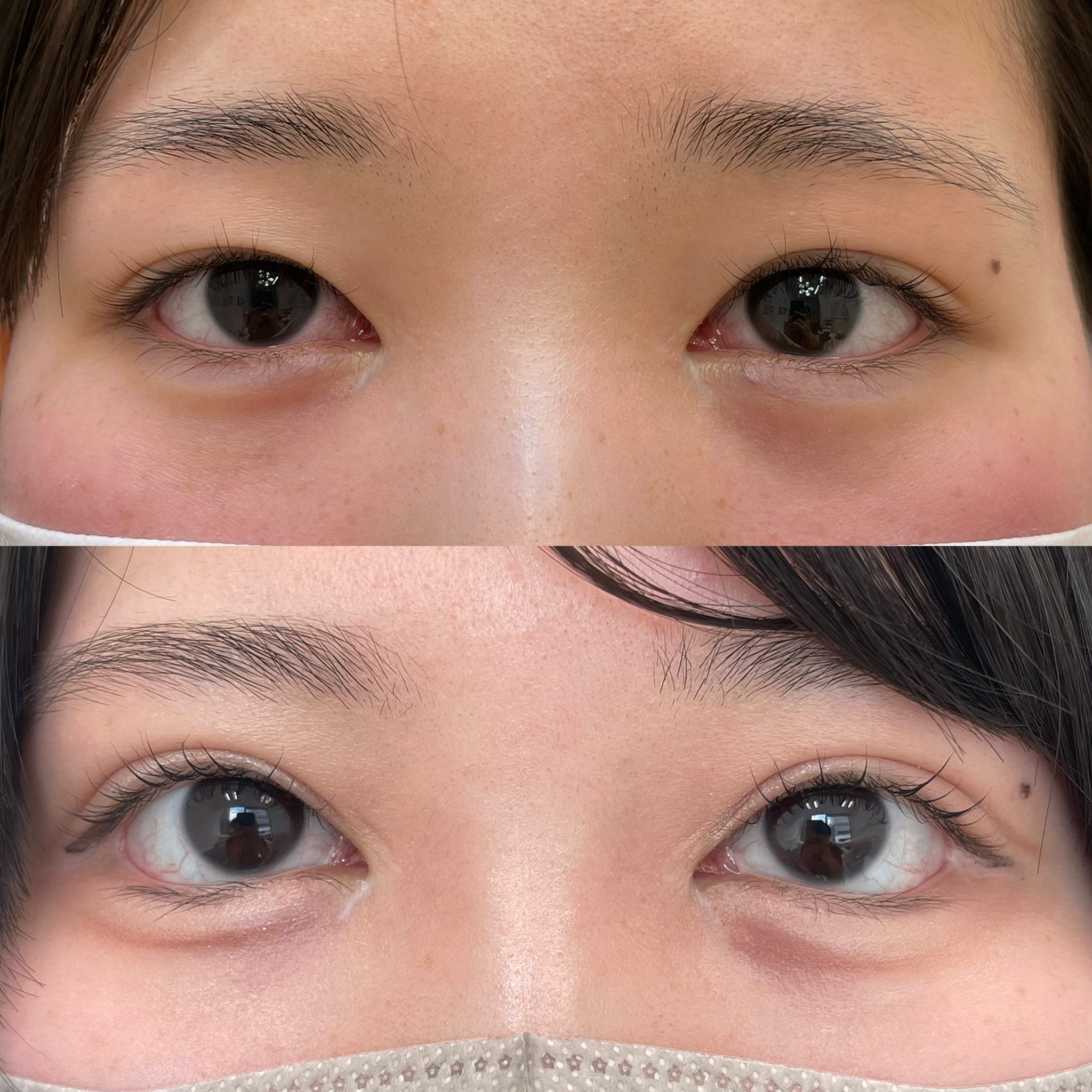 目尻靱帯固定術、目尻切開、たれ目形成術（グラマラスライン