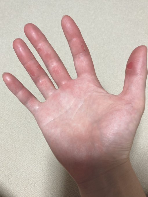 久しぶりにゴルフしたら力んで皮めちゃ剥けた～ https://t.co/c57UN8p2Ow