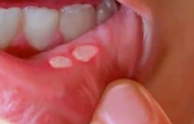 Şu beyaz yara nasıl geçer Allah rızası için biri söylesin ?