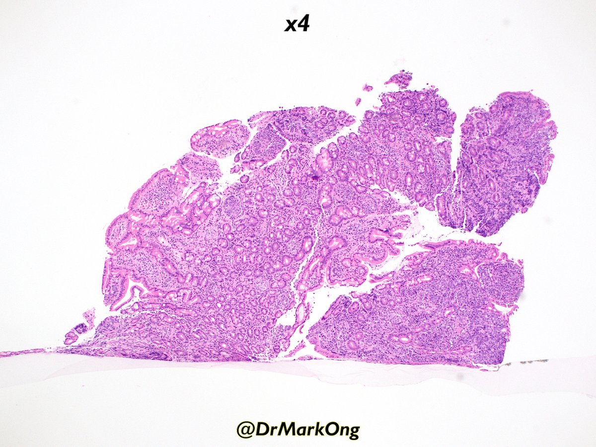 DrMarkOng's tweet photo. Distal gastric/duodenal mass.

What's your differential diagnoses and approach?

#GIpath #pathology https://t.co/ivqy5yyPti