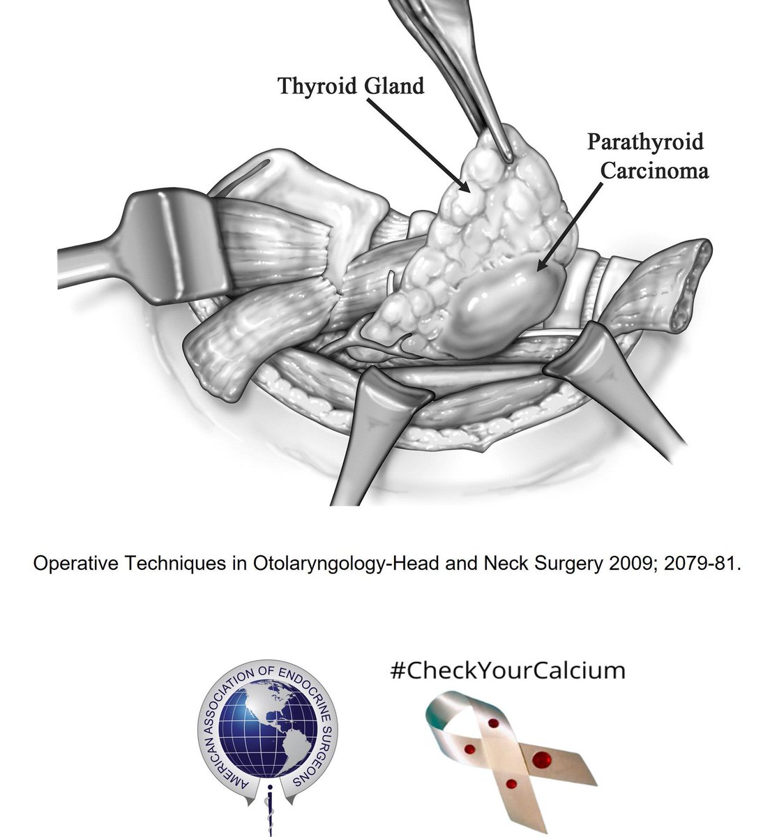 TheAAES's tweet image. Parathyroid cancer is extremely rare, occurring in &amp;lt;1% of patients with high calcium and PTH levels. Patients with parathyroid cancer usually have very high calcium (often &amp;gt;14mg/dL) &amp;amp; PTH and a very large parathyroid gland. #CheckYourCalcium #PAM2024 @ParaTroupers1