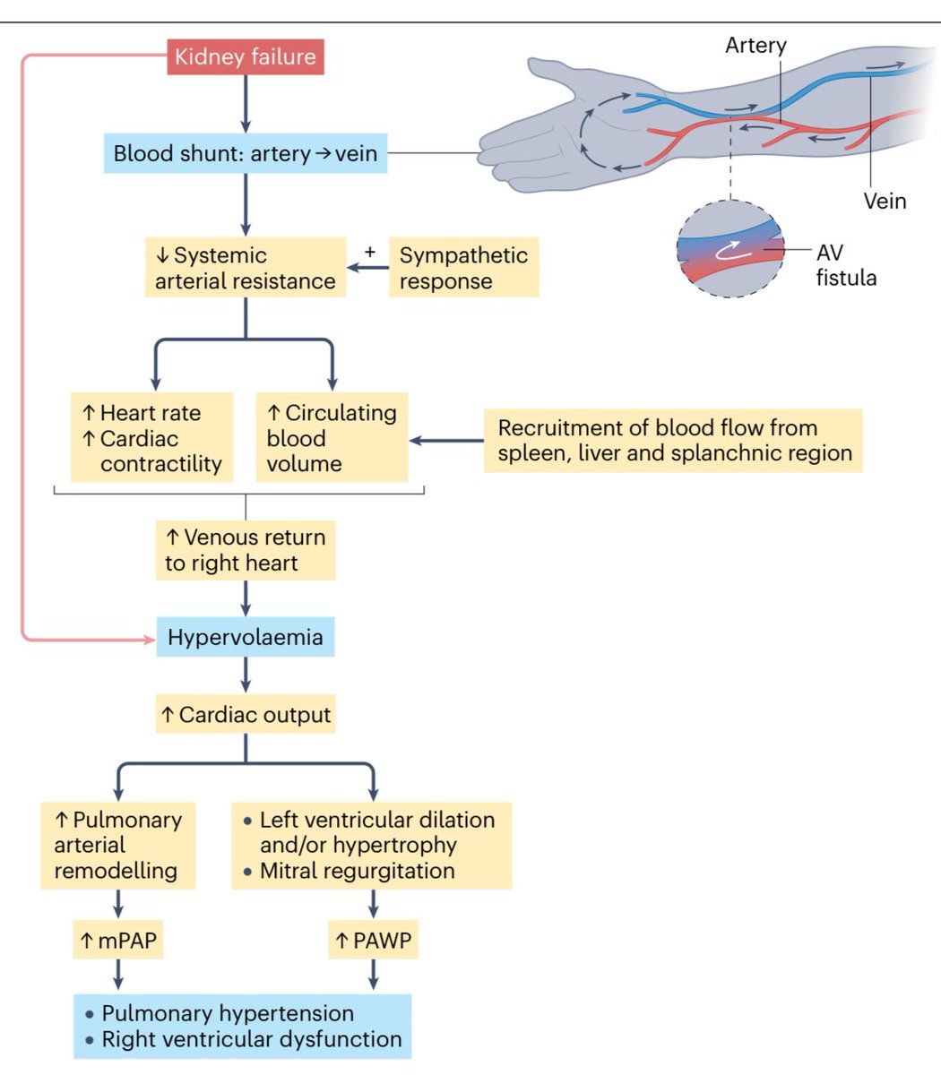 La fístula arteriovenosa para hemodiálisis, ↑gasto cardiaco, el relodelamiento arterial pulmonar e hipertensión pulmonar precapilar, regurgitación mitral, culminando en disfunción ventricular derecha

#ISNyoung

Nat Rev Nephrol 2024
10.1038/s41581-024-00857-7