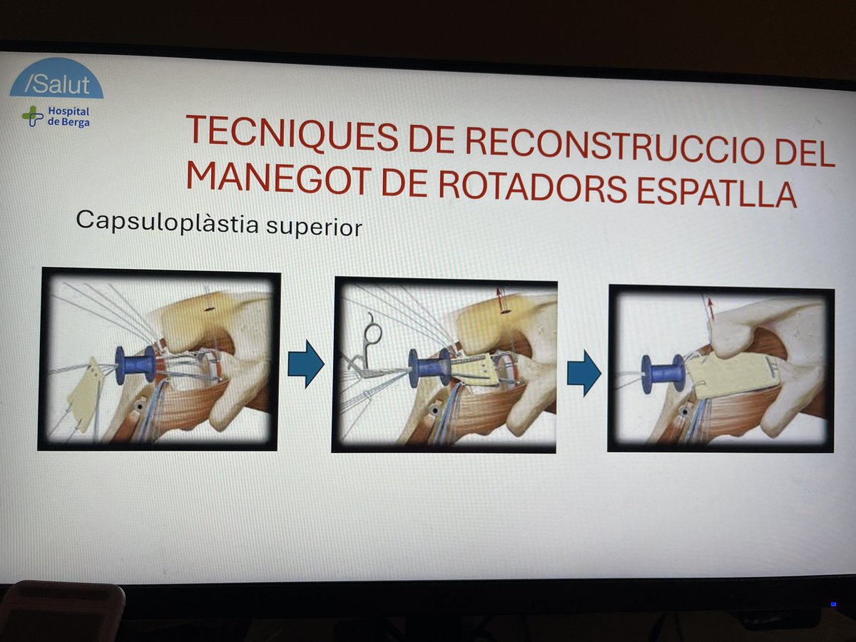 Presentació “Tècniques de reconstrucció del manegot de rotadors d’espatlla” Sessions Catalunya Central (Manresa-Berga): la nostra experiència en capsuloplàstia superior, baló subacromial i transferència dorsal ample. #prifberga #capsuloplastia #berga #hospitaldeberga