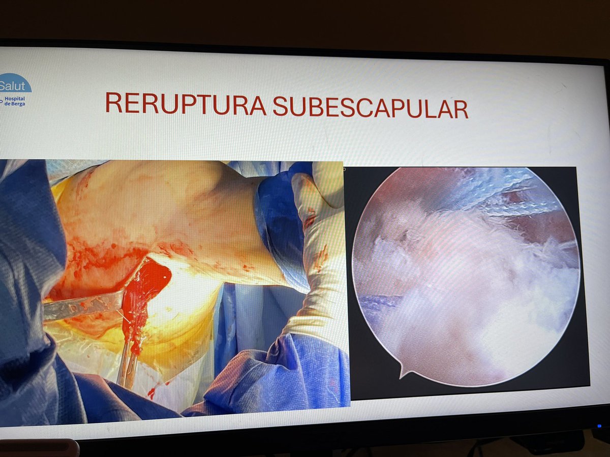 Transferència del dorsal ample per davant espatlla per suplir reruptura inveterada de subescapular: reequilibri anteroposterior #roturasubescapular #manguitorotadores #prifberga #hospitaldeberga <a href="/HospitaldeBerga/">Hospital de Berga</a> @drpmir <a href="/PRIFBerga/">PRIFBerga</a> <a href="/sccot_cat/">SCCOT</a>