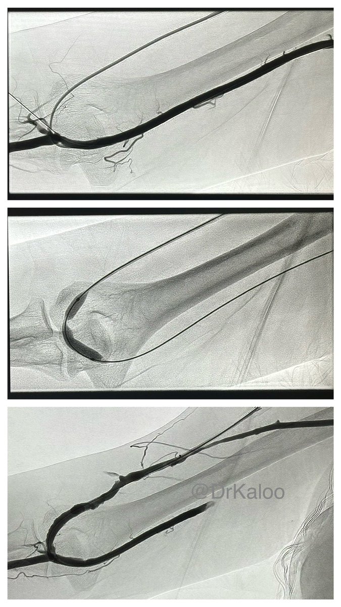 DrKaloo's tweet image. Dialysis fistula is lifeline of chronic kidney disease patients

This #fistula was abandoned 3 months ago after it stopped functioning

We were able to get it back to function with #angioplasty. 

#InterventionalRadiology #iRad #DrKaloo #MaxHealthcare #MaxHospital