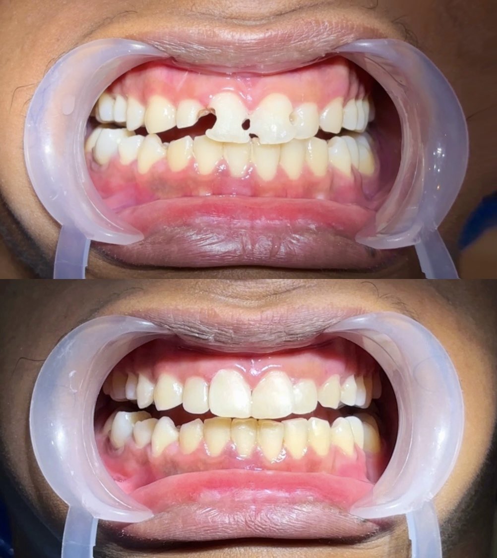 dailydoseofmood's tweet image. today’s work: direct anterior 12 11 21 22
#directcomposite