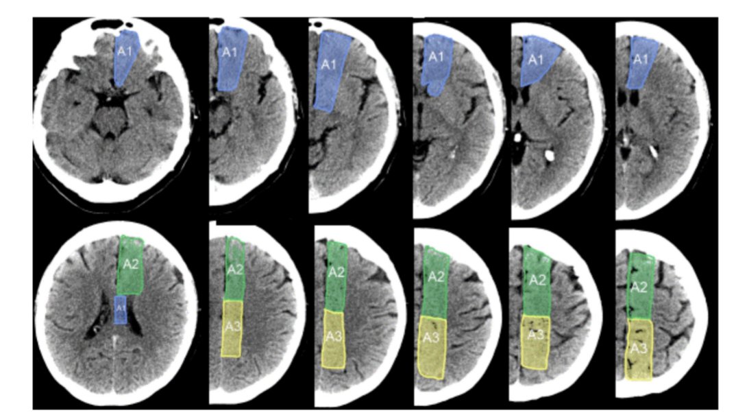 neurona_critica's tweet photo. AC-ASPECTS, ACh-ASPECTS, and H-ASPECTS: new imaging scales to assess territorial and total cerebral hemispheric ischemic injury

https://t.co/DCgnJ8JknJ

Felicitaciones @Mapazrodri @dliebesk https://t.co/X3I0Nhpioy
