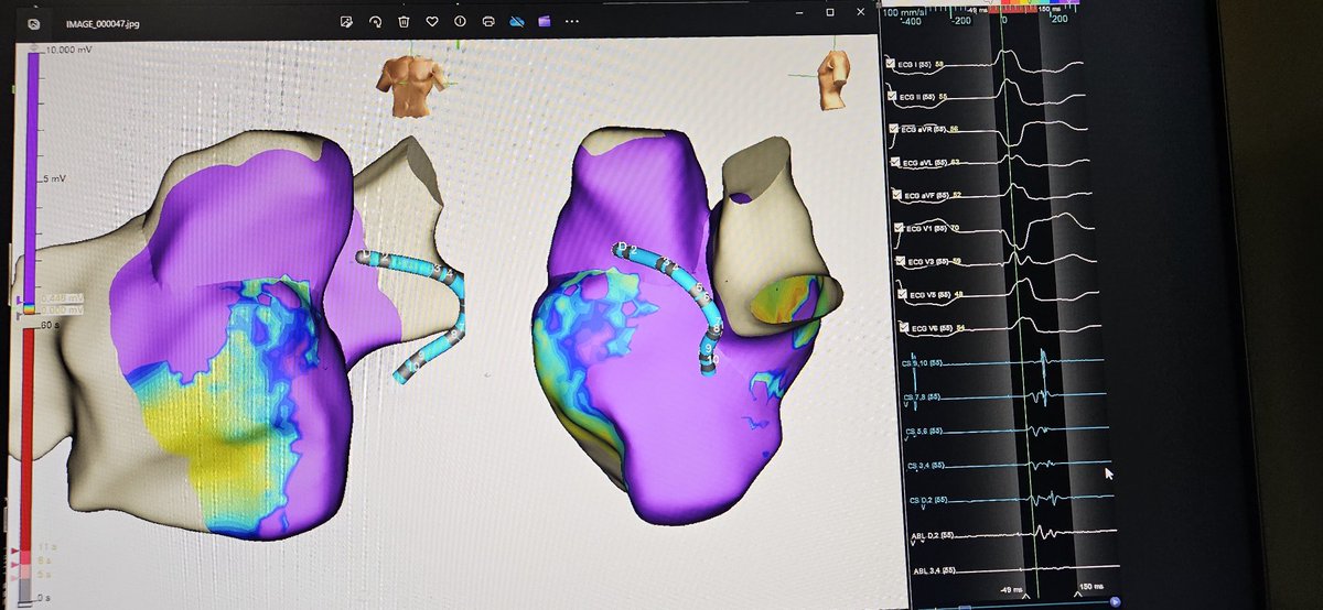 Ablation on pathway gone #EPeeps
