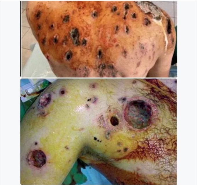 اسرائیل نے ہمارے شہریوں پر فاسفورس بم گرایا۔

دیکھنا بہت تکلیف دہ ہے 💔

#نکلوفلسطین_کی_خاطر