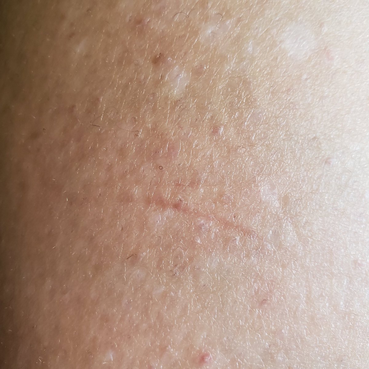 TJ60002076415's tweet image. I wake up with marks like this on my body. They weren't there when I went to bed. Not from my feline roommates either. 
#TI #morgellons