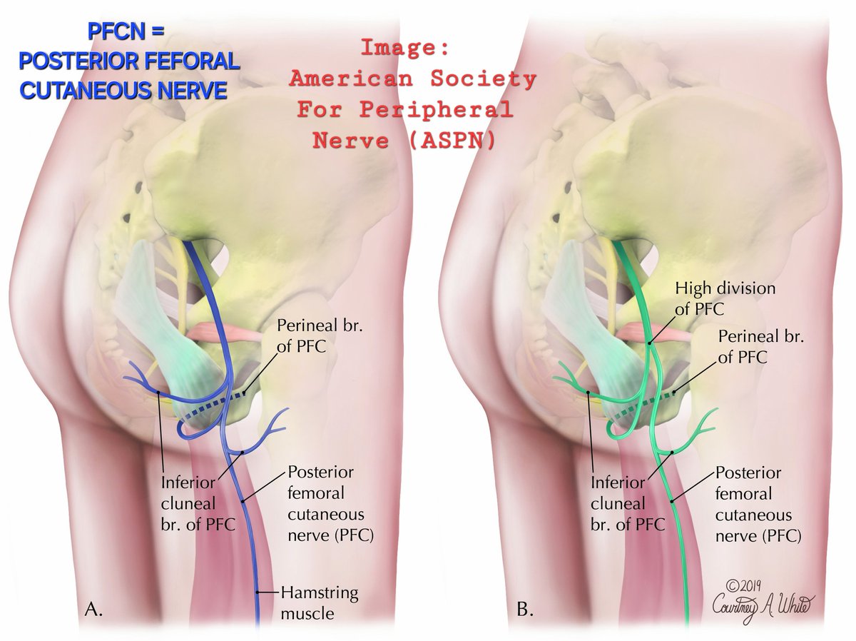 Sitting pain due to injury to PFCN, is pain in lat buttock,post thigh,ischial tuberosity &amp;can be relieved by PFCN resection with implantation of proximal end into gluteus muscle. Presence of anatomic variation,a high division of PFCN,preserve sensation in lat buttock &amp;post thigh.