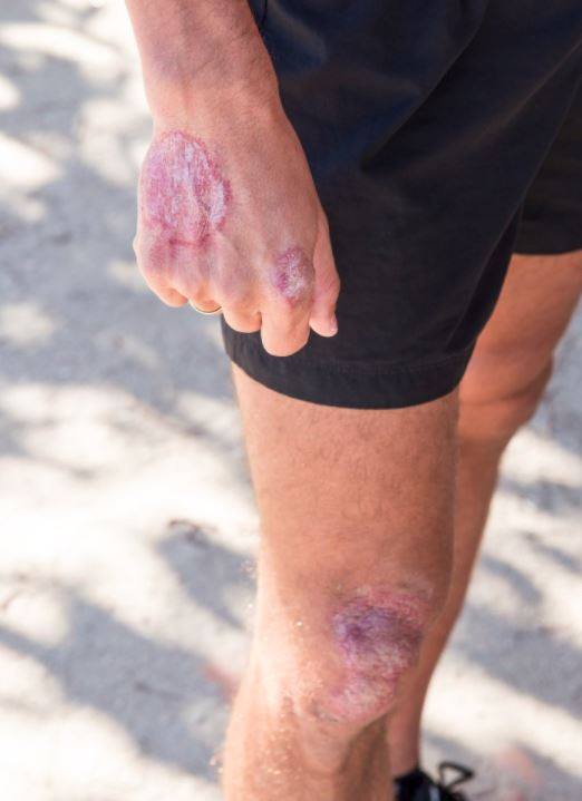 accionpsoriasis's tweet photo. 🌴👙 Este verano, si ves a alguien con estas marcas, no te extrañes: es #psoriasis, una enfermeda inflamatoria del sistema inmunitario que puede afectar la piel, las uñas y las articulaciones. Aparece en brotes y NO se contagia. ¡Comparte!  ℹ️ https://t.co/svRbfVJlHu https://t.co/l04uytyC5Q