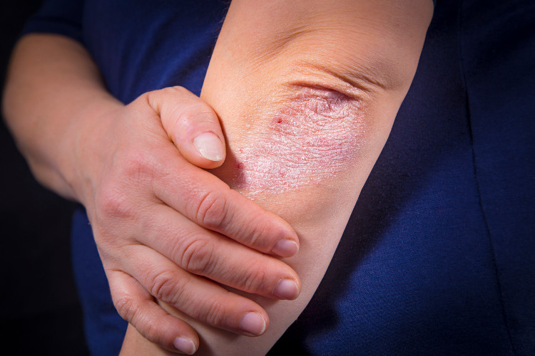 accionpsoriasis's tweet photo. 🌴👙 Este verano, si ves a alguien con estas marcas, no te extrañes: es #psoriasis, una enfermeda inflamatoria del sistema inmunitario que puede afectar la piel, las uñas y las articulaciones. Aparece en brotes y NO se contagia. ¡Comparte!  ℹ️ https://t.co/svRbfVJlHu https://t.co/l04uytyC5Q