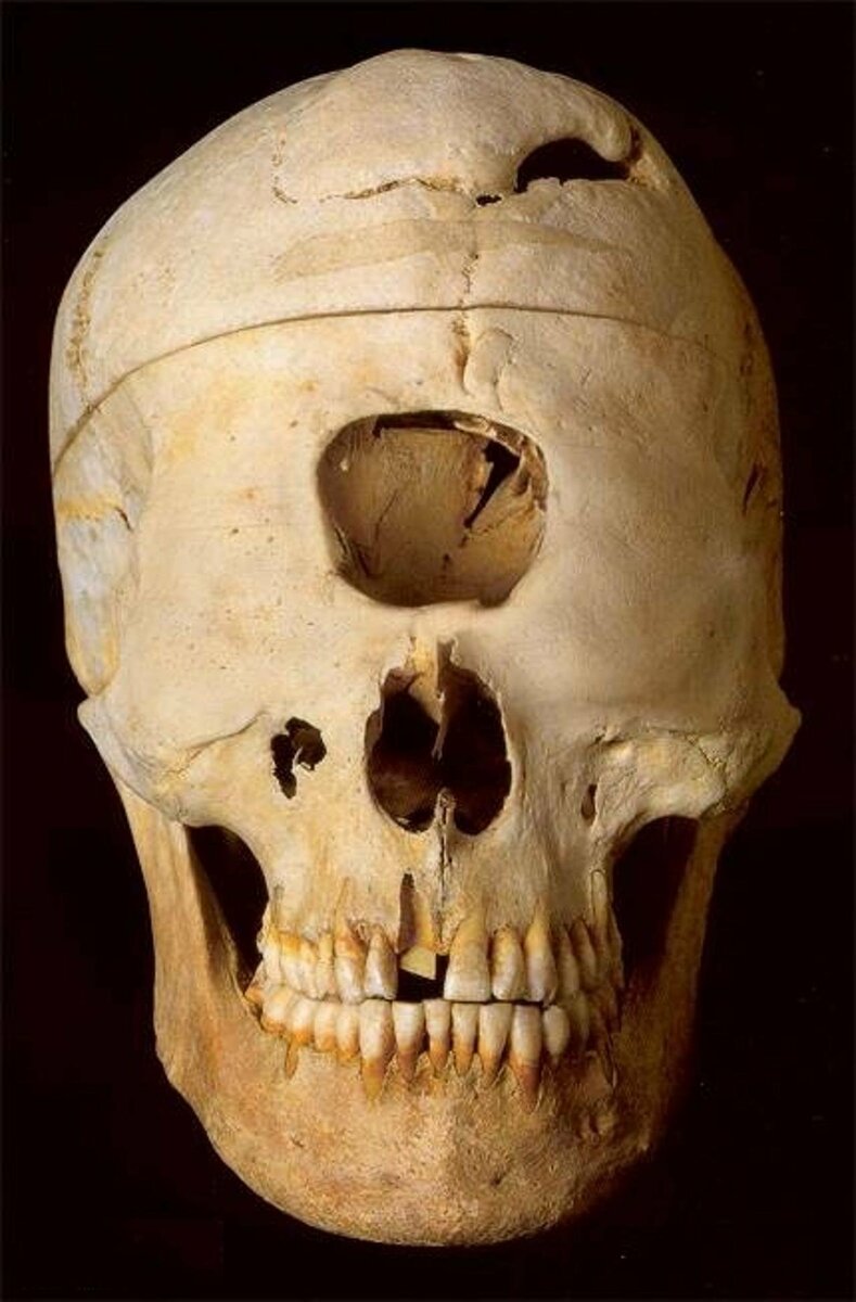 uzunsimsekersin's tweet photo. In #Greek🇬🇷 mythology, overhead gazes really existed, and this disease is actually #CYCLOPIA . in #Homer's Odyssey and Iliad epic, he talks about overhead gazes . https://t.co/NkLv3sRq9c