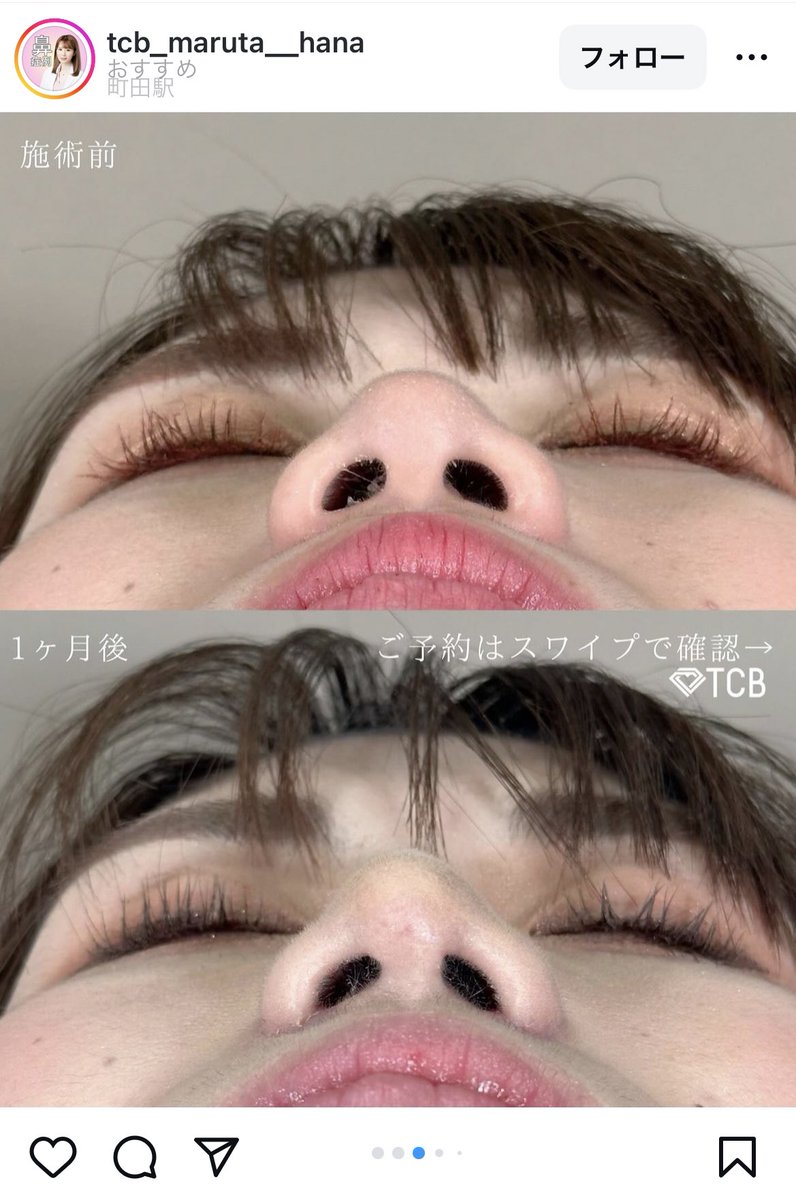 syuseikibou's tweet photo. この全く変化のないゴミ施術
なんなら鼻が曲がっただけのクソ症例をドヤ顔であげちゃうTCBのゴミさ加減一体どうにかならんのん？

この方大金はらって鼻曲がっただけやん https://t.co/B3MXVj16AM