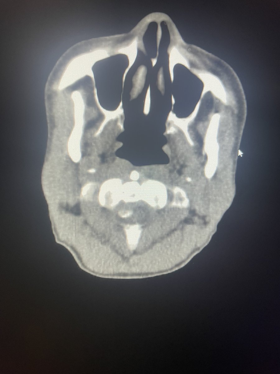 bejit1's tweet photo. https://t.co/GzshR6Azdn Case of the Week From 7/14/24

History: Neck pain. History of breast cancer.
What are the findings? 
What is the differential? 
Are schwannomas FDG avid? 
https://t.co/4uBSoW3v9R
#nuclearmedicine #FDG #PETCT #metabolism #schwannoma #meningioma #neuro https://t.co/ZCNJ10tLic