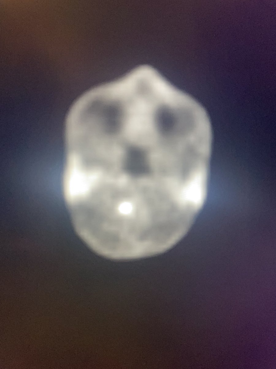 bejit1's tweet photo. https://t.co/GzshR6Azdn Case of the Week From 7/14/24

History: Neck pain. History of breast cancer.
What are the findings? 
What is the differential? 
Are schwannomas FDG avid? 
https://t.co/4uBSoW3v9R
#nuclearmedicine #FDG #PETCT #metabolism #schwannoma #meningioma #neuro https://t.co/ZCNJ10tLic