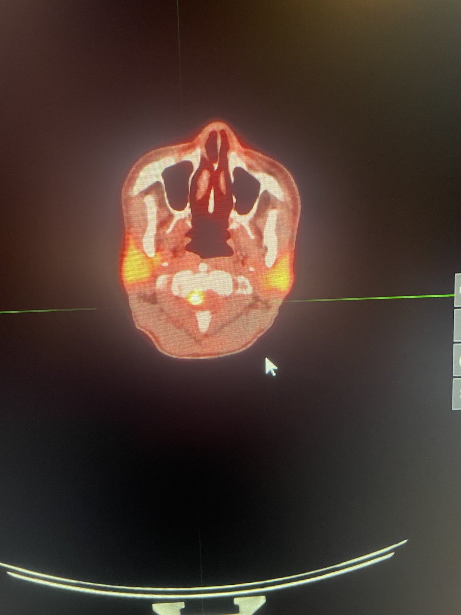 bejit1's tweet photo. https://t.co/GzshR6Azdn Case of the Week From 7/14/24

History: Neck pain. History of breast cancer.
What are the findings? 
What is the differential? 
Are schwannomas FDG avid? 
https://t.co/4uBSoW3v9R
#nuclearmedicine #FDG #PETCT #metabolism #schwannoma #meningioma #neuro https://t.co/ZCNJ10tLic