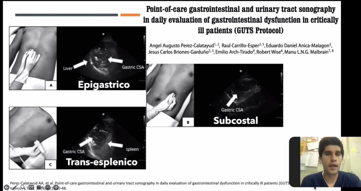 ATIPNL1's tweet photo. Se llevo acabo nuestra sesión del mes de julio con la exposición de Dr Aarón Rodríguez Sánchez y las barreras para la nutrición en pacientes pediatricos graves. @drdavidhdez #PedsICU #ATIPNL https://t.co/4U0DvDyqse