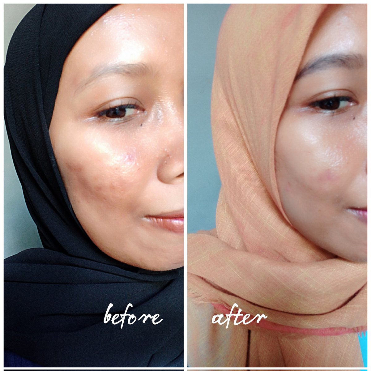 lilssst's tweet photo. @ElformulaID Nah, peeling serum ini digunakan malam hari aja yaa.
Cara pakainya cukup diratakan dan tunggu 1menit , lalu bilas deeh.
Abis itu lanjut moist terus paginya jangan lupa pakai sunscreen.
#racuninskincare #peeling #exfo https://t.co/2Ke8XZb8i9