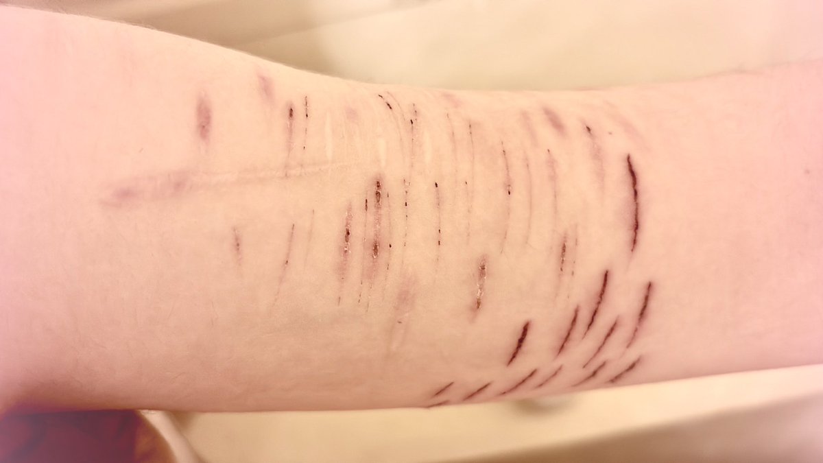 all my scars in different stages of healing :3