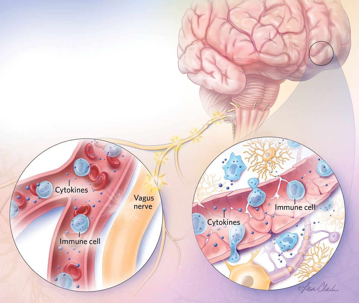 Vipin M. Vashishtha (@vipintukur) on Twitter photo THE INFLAMED BRAIN!
Autoimmune conditions underlie some cases of psychosis. Scientists are expanding their search for patients, who often benefit from treatment. 1/ THE INFLAMED BRAIN!
Autoimmune conditions underlie some cases of psychosis. Scientists are expanding their search for patients, who often benefit from treatment. 1/