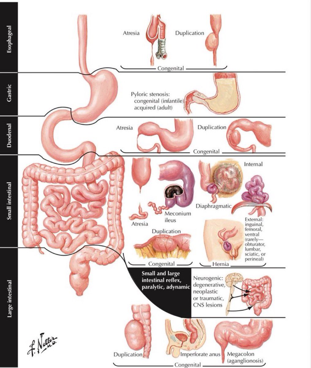 Causes of Intestinal Obstruction