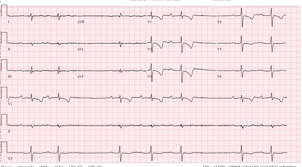 syamkumarmd's tweet photo. Case of group beating and physiology. #EPeeps #Fellowsfirst
Thanks, @ArshaKarbassi, for this ECG https://t.co/S87TcVLYmp