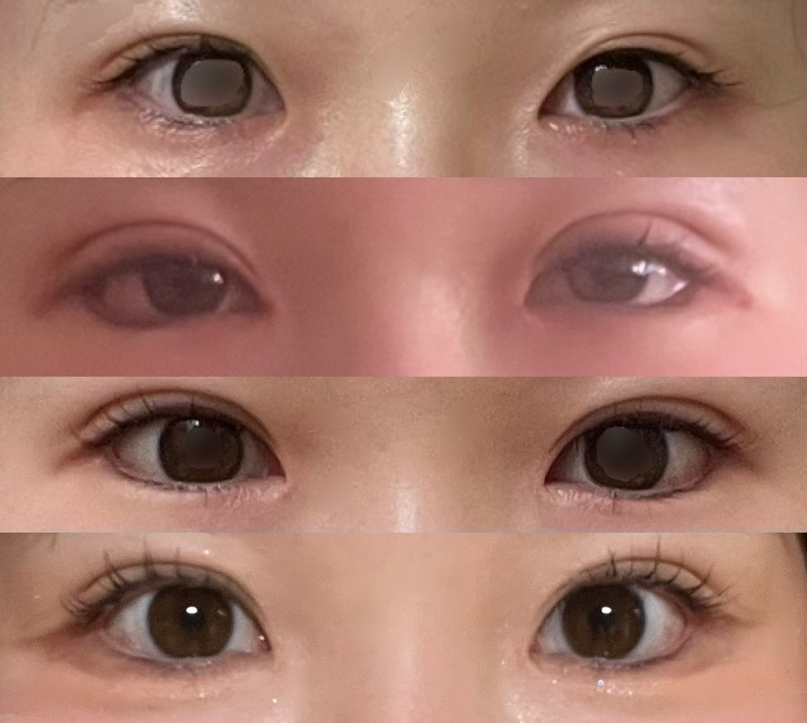 nnpch__'s tweet photo. ZESTAR美容外科＠zestarpsさんで目フル（埋没修正、目頭目尻目下切開）を行って3ヶ月経ちました〜！ https://t.co/XbRE25bAA8