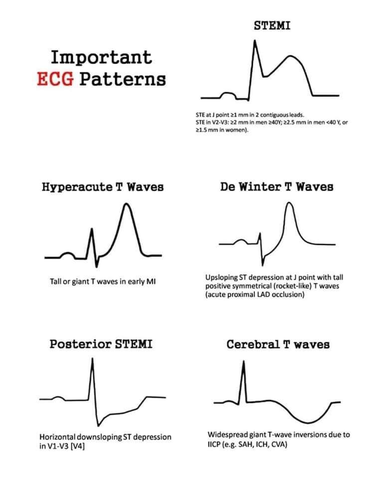 ZHeart11768530's tweet photo. 🔴 Important ECG Patterns 🫀 

#MedEd #MedTwitter #FOAMed #ECG  #Cardiotwitter #medicalstudent #ekg #cardiology https://t.co/7mIoxh4Qpq