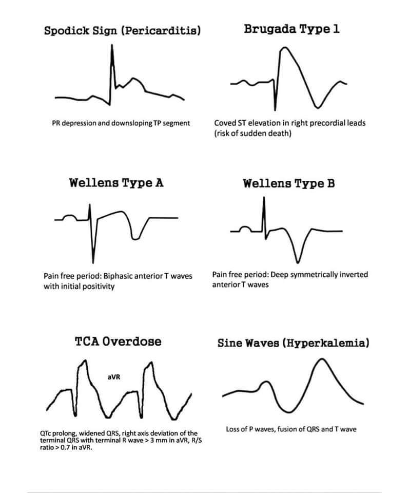 ZHeart11768530's tweet photo. 🔴 Important ECG Patterns 🫀 

#MedEd #MedTwitter #FOAMed #ECG  #Cardiotwitter #medicalstudent #ekg #cardiology https://t.co/7mIoxh4Qpq