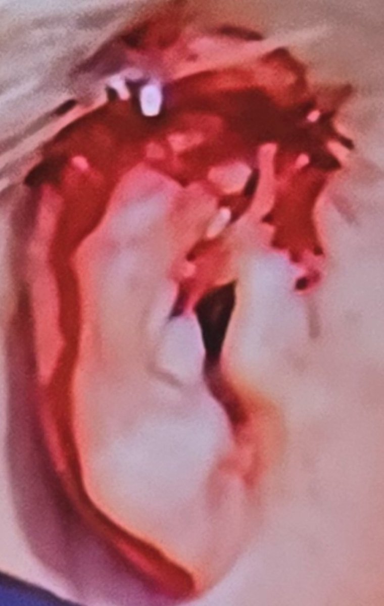 TaylorK88114500's tweet photo. #Trump #trump2024 #maga #Staged #BloodBag #Wipe @GOP #Republican #FakeNews #Conservatively Takes His Ear Off
Look closely at the ear 👂, which part of the ear sustained the AR15 Shot 💥
Bullets are out of round and Wabble in the Air, any impact it would have exploded that area https://t.co/VwGkepLkf5