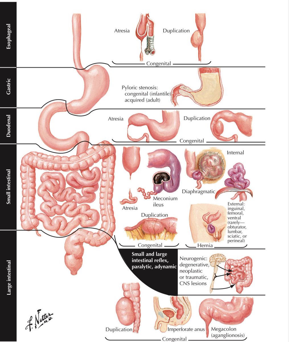 drteoa's tweet photo. Causas de obstrucción intestinal (pt1) https://t.co/WtD66rZQlQ