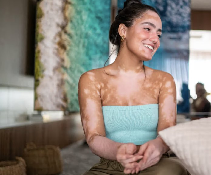 zizelle_'s tweet photo. • Acrofacial Vitiligo which affects the face, hands and feet.

• Mucosal Vitiligo which affects mucous membranes of the mouth, nose and genitals.

• Localized Vitiligo which affects just a few areas of the body.

• Universal Vitiligo which affects 80-90% of the skin. https://t.co/S4hNqr5C87