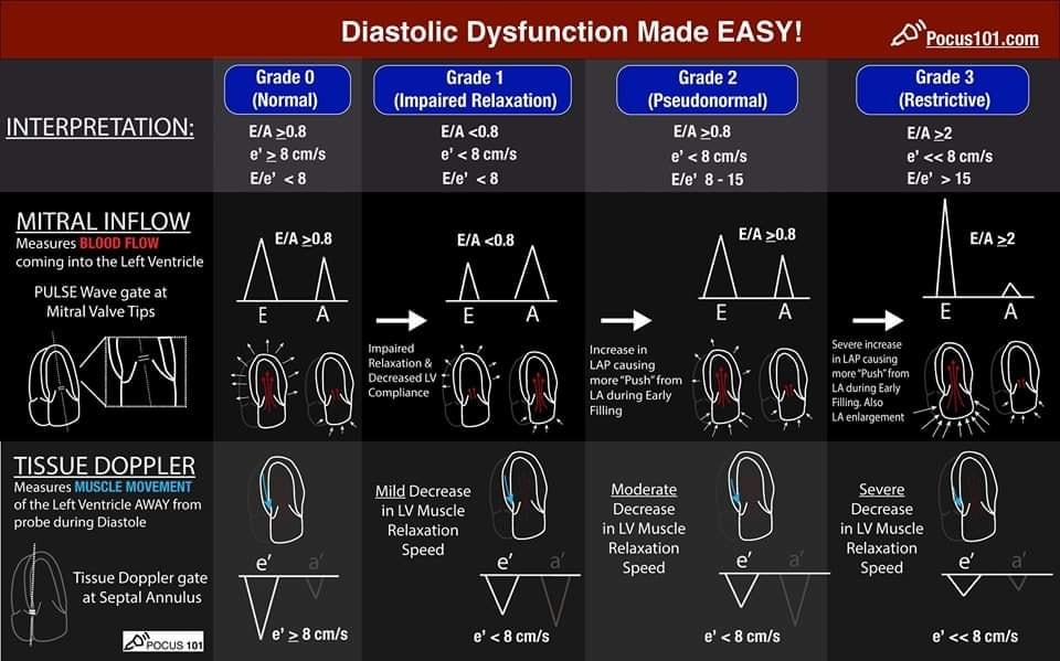 ZHeart11768530's tweet image. 🔴 How to Measure and Grade Diastolic Dysfunction using Echocardiography

🔹Grade 0  (Normal)
🔹Grade 1 (Impaired Relaxation)
🔹Grade 2 (Pseudonormal)
🔹Grade 3 (Restrictive) 
pocus101.com/how-to-measure…
#diastology #Diastolic #Dysfunction #Grading #Echocardiography #echocardiogram