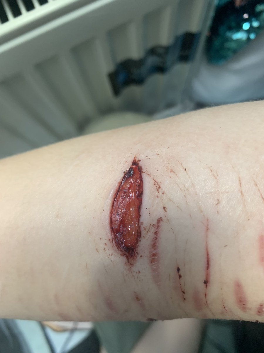 adeleiscoolie's tweet photo. healing process 

TW: SH 

it’s fascia too, its closed up now but i saw fascia guys im so happy https://t.co/020IBn4BPt
