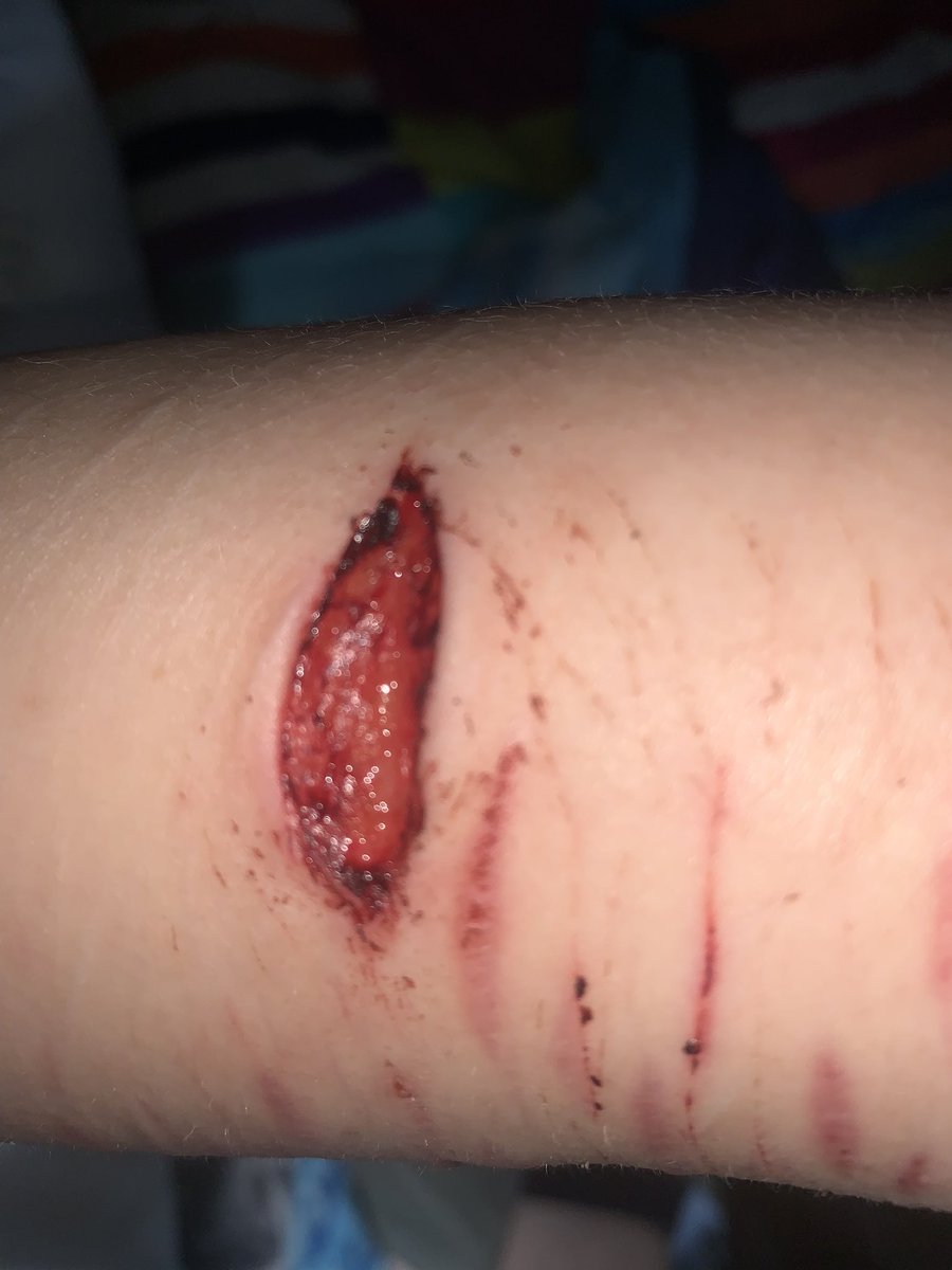 adeleiscoolie's tweet photo. healing process 

TW: SH 

it’s fascia too, its closed up now but i saw fascia guys im so happy https://t.co/020IBn4BPt