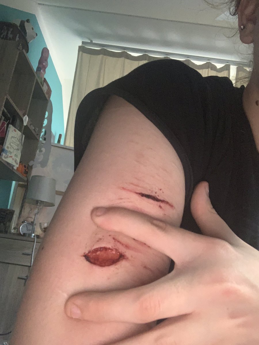 adeleiscoolie's tweet photo. healing process 

TW: SH 

it’s fascia too, its closed up now but i saw fascia guys im so happy https://t.co/020IBn4BPt
